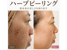 ラヴィアンローズ 岐阜本店(La vie en Rose)の雰囲気（ILLONハーブピーリング　５回施術）