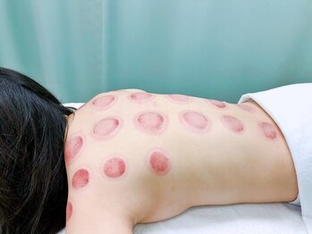 たくみ整体院/吸い玉