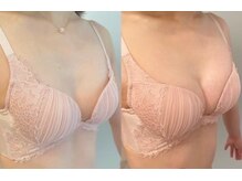 美人バスト アンド ヒップアップ 広島店/バストアップ症例写真