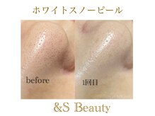 アンドエスビューティ(&S Beauty)の雰囲気（乳酸ピーリング！！毛穴/シミ/しわ/ニキビケアに◎）