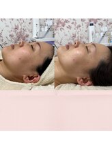 メイト(mate)/肌質改善＜リフトアップ＞