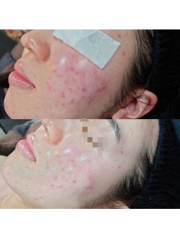 ボーソリューション(Beau-Solution)/【20代　赤みニキビケア】