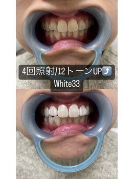 アイブロウ33 久留米店/【ホワイトニングBefore After】