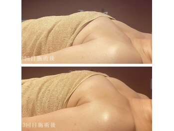 ネイト ワックス(Neit Wax)/バスト3回ビフォーアフター