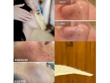 松ヤニWAXで肌質、毛穴、ニキビ改善♪