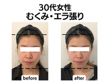 シン(SHINE)/美容鍼灸