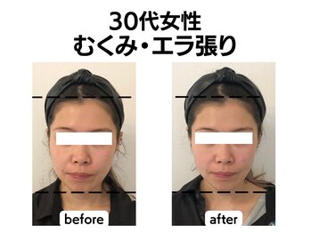 シン(SHINE)/美容鍼灸