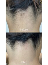 テラスアヴェダビューティー 岡山(Terrace Aveda beauty)/脱毛前の襟足づくり