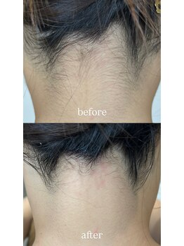 テラスアヴェダビューティー 岡山(Terrace Aveda beauty)/脱毛前の襟足づくり