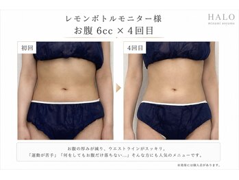 ハロ 南青山(HALO)の写真/【外苑前5分/表参道8分】レモンボトル×ボディスタンプ☆お腹・太もも・二の腕など/気になる部分を集中ケア