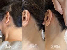 エリクサー 熊谷店(Elixir)/うなじ2回照射後