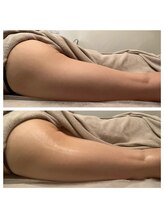 スターエステ(STAR ESTHE)/太もも、１回でこんなにほっそり