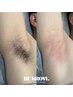 イイ女の身だしなみ！ワキ脱毛最新ハイブリット美容脱毛！¥3,000