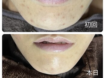 リボーン(REBORN)/部分的にハーブピーリング