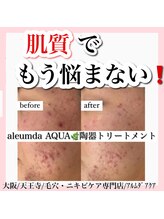 アルムダアクア 天王寺店(Aleumda AQUA)/ハーブピーリング/大阪/天王寺