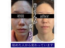 ユウェール(JUWEEL)の雰囲気（再発させないニキビ撲滅！肌土台作り/圧倒的鎮静効果で根本から）