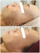 エルール トータルビューティ(Aileure total beauty)/肌質改善ララピール