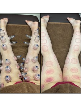 エムズビューティーサロン(M's Beauty Salon)/【3】カッピング