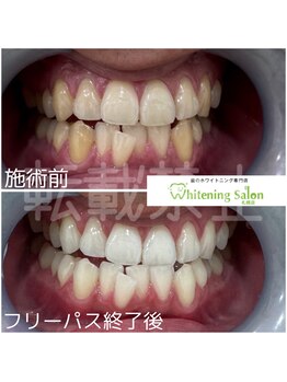 ホワイトニングサロン 札幌店/【ホワイトニング】#札幌#大通り