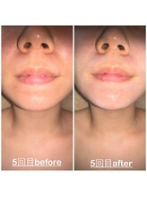 ミニョン(mignon)/顎ニキビ、ほうれい線