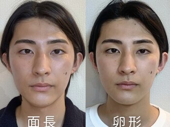 ナビレラ(navillera)/施術2回で面長から卵形へ