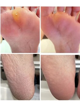 ミヨン 喜多見店(Miyong)/足裏角質ケア