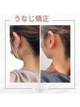 ミース 宮崎店/こんなに変わるうなじ矯正
