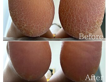 カシェット 広島店(Cachette)/40代女性☆足裏角質ケア90分