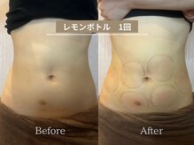 スマイルビューティラボ 別府店(Smile Beauty lab.)/レモンボトル痩身☆