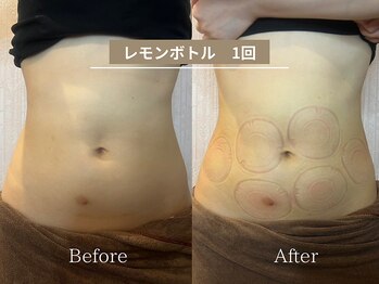 スマイルビューティラボ 別府店(Smile Beauty lab.)/レモンボトル痩身☆