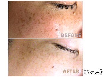 ウィズマツオカ 光の森店/シミ集中デトックスケア