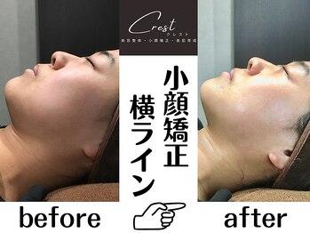 クレスト(CREST)/ビフォーアフター【小顔名古屋】
