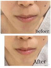 リッチベル(richbelle)/ハーブピーリング初回（口元）