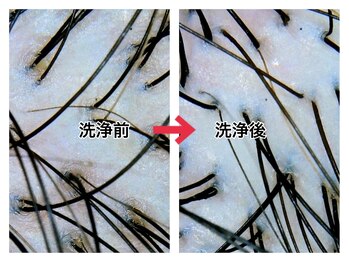 スーパースカルプ 大津店(SuperScalp)/頭皮洗浄before/after