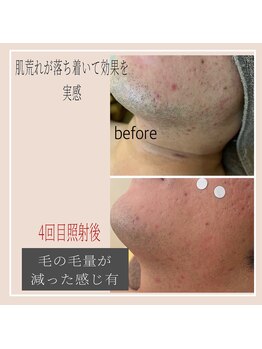 リリールア(Rere-Rua)/メンズ脱毛★