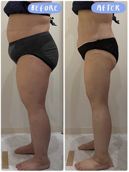 ヴォアール 東静岡店(VOIR)/2ヶ月本気痩せ脂肪冷却