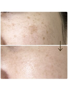 スーン(soon)/シミとハリ弾力にアプローチ♪