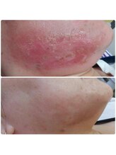 ニカ(NiCA)/8日間　7回照射