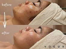 ボウ 名古屋店(VOEUX)/２０代　ニキビ　８回