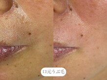 フラックス 京都(FLUX)/【ワックス脱毛】フェイシャル