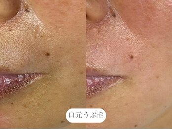 フラックス 京都(FLUX)/【ワックス脱毛】フェイシャル