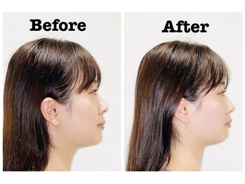 鍼灸マッサージ院 長津田駅前整骨院/美容鍼　before after