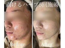 アブニールブリヨンの雰囲気（剥けるハーブはニキビの鎮静、ニキビケアが大得意！◎[肌質改善]）