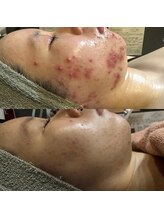 アルム(a'rme)/【ニキビ】