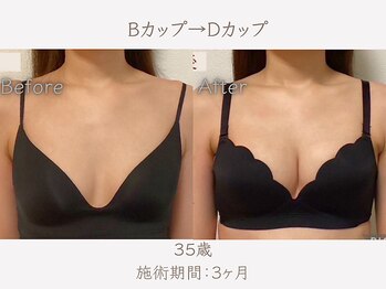 ハリスタ 西宮院(HARISTA)/3ヶ月間でBカップ→Dカップ