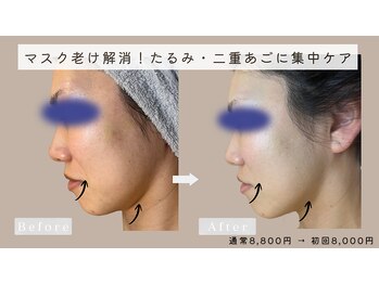 ユヌランコント 岐阜店(Une rencontre)/リフトアップコース