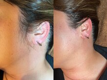 ゴールデンエイジ 吉祥寺(GOLDEN AGE)/ワックス脱毛：施術