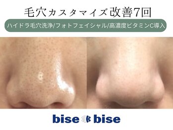 ビズビズ 天王寺店(bisebise)の写真/夏の毛穴リセット！【医療提携】毛穴黒ずみ詰まり/角栓/いちご鼻/毛穴開き/頬たるみ毛穴に特化した毛穴専門