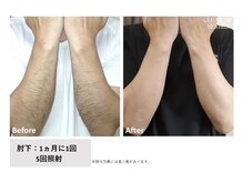 ロカビリー(Rockabilly)/メンズ　腕脱毛