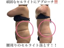 痩身革命 大宮店/施術写真（痩身）
